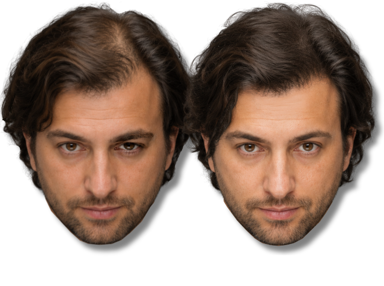 Before and after comparison of a man's SMP showing improved hair density and volume.