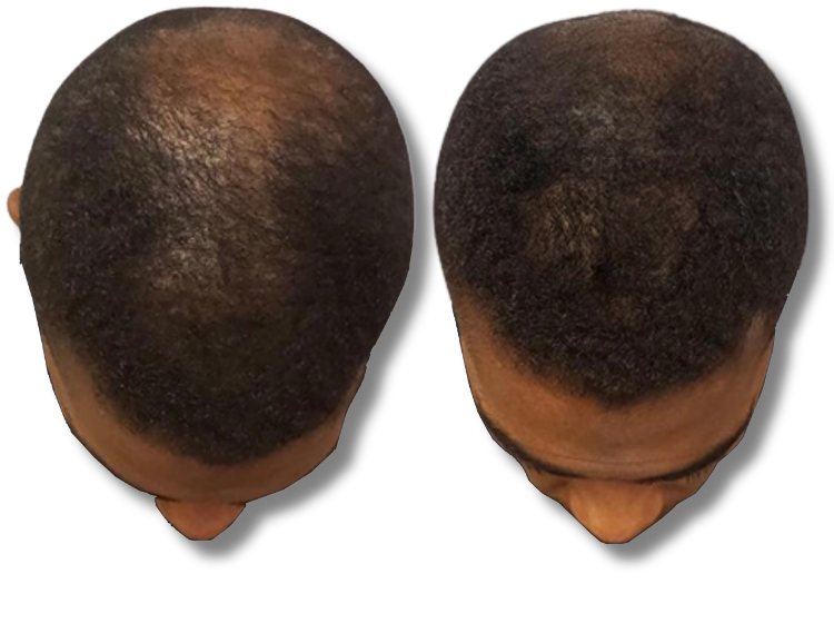 Before and after results of hair restoration showing increased hair density and regrowth on the crown.