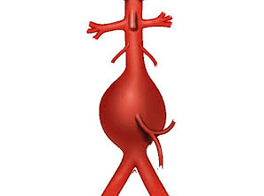 vascular ultrasound artery abdominal aorta aneurysm back pain bulge blood symptoms rupture risk factors treatment stent aaa
