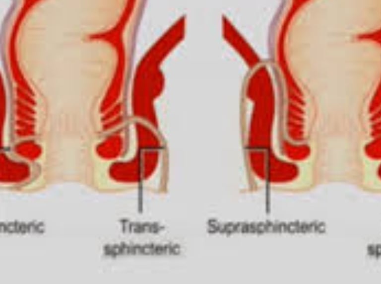 The use of honey in the management of anal fistulas may reduce pain and facilitate healing