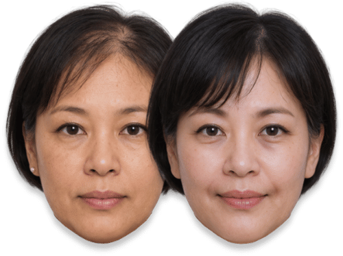 Before and after results of SMP treatment and skin rejuvenation for an Asian woman.