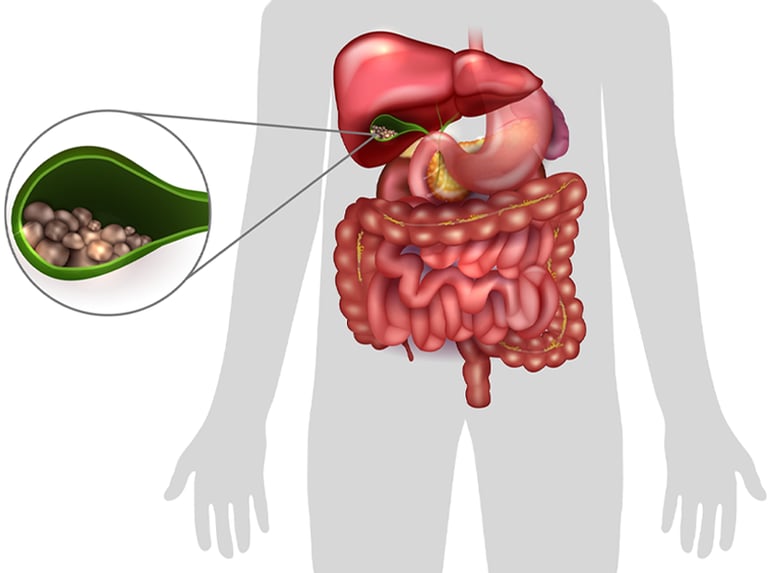 imagem ilustrativa parede de calculos biliares