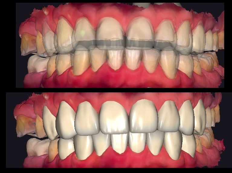 Diseño de sonrisa digital en distalclinic