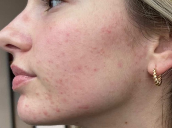 before mcironeedling results after 4 procedures