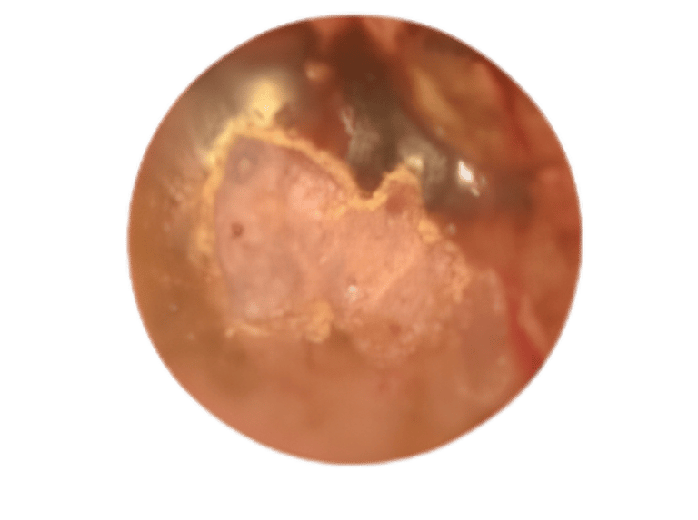 фото Мілія на матці