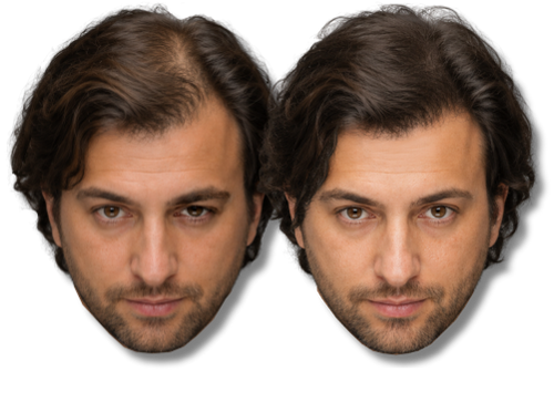 Before and after of a mans SMP hair restoration treatment showing increased hair density and volume.