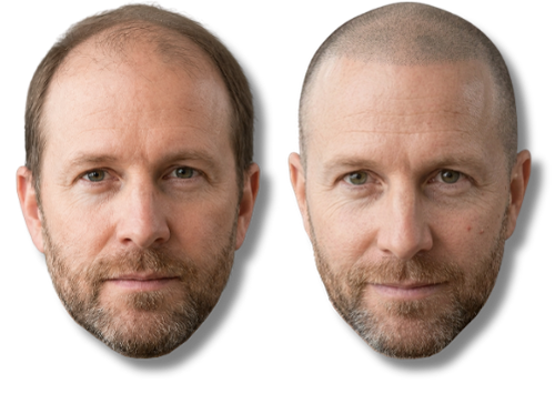 Before and after scalp micropigmentation results for male pattern baldness treatment.