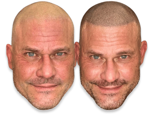 Before and after scalp micropigmentation treatment for male pattern baldness and hair density.