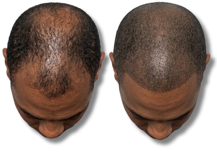 Before and after comparison of scalp micropigmentation for male pattern baldness and hair density.