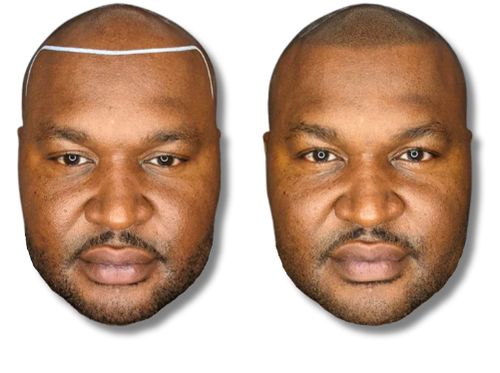 Before and after scalp micropigmentation showing a restored hairline and denser hair for men.