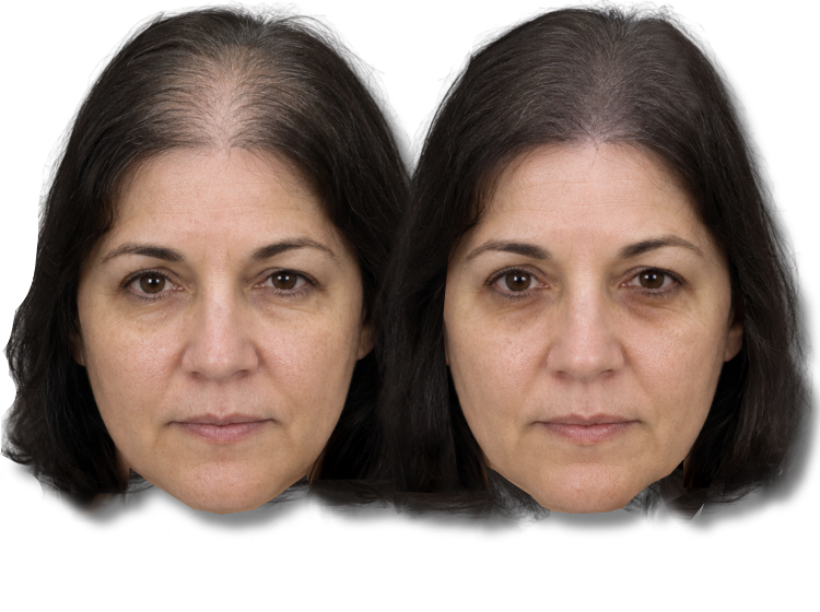 Before and after comparison of female SMP treatment results on a woman's scalp.