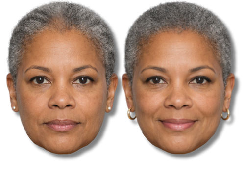 Before and after comparison of a smiling woman showing SMP results.
