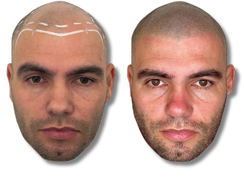 Before and after scalp micropigmentation results for a bald man showing a natural hair tattoo hairli
