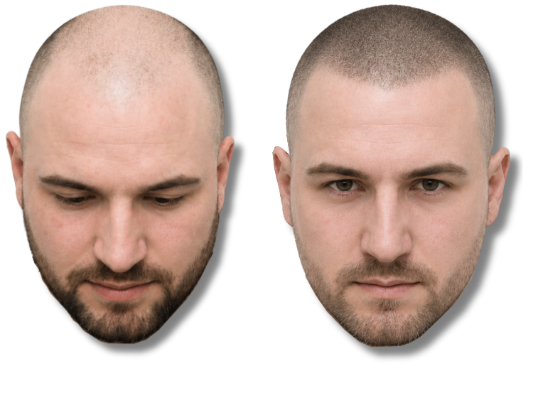Before and after comparison of scalp micropigmentation for male pattern baldness and hair thinning.