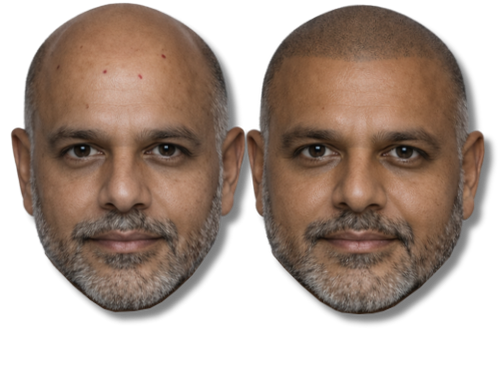 Before and after scalp micropigmentation treatment for male pattern baldness and hair density.