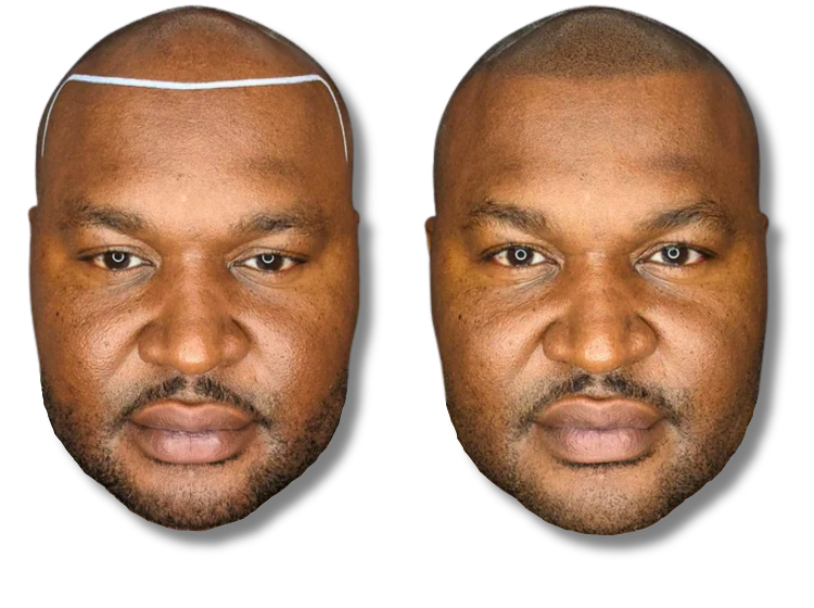 Before and after scalp micropigmentation for hair loss showing a restored hairline on a bald man.
