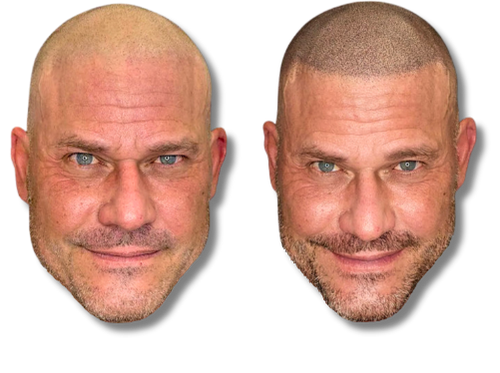 Before and after scalp micropigmentation treatment showing a realistic hairline tattoo on a bald man.