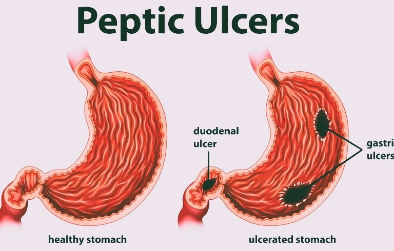 peptic ulcers