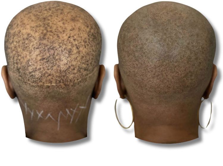 Before and after results of scalp micropigmentation for thinning hair and scar camouflage.