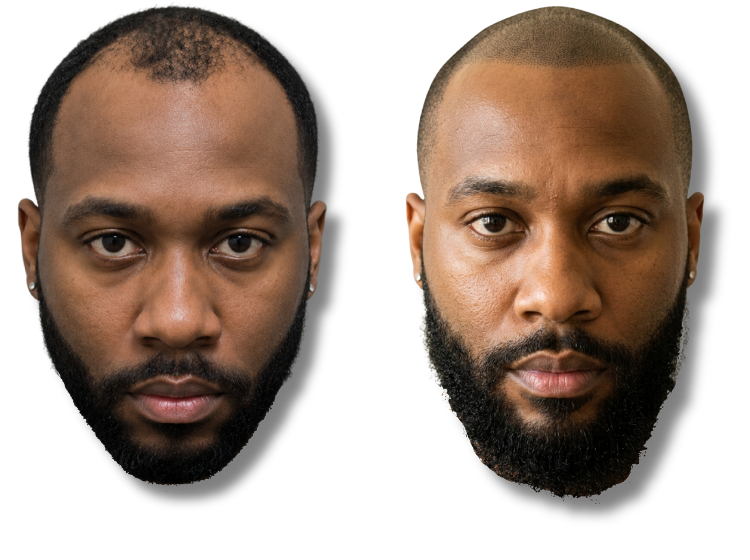 Before and after scalp micropigmentation results for a man with male pattern baldness.