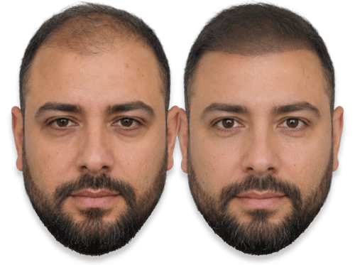 Before and after comparison of a man's SMP results showing a restored hairline.