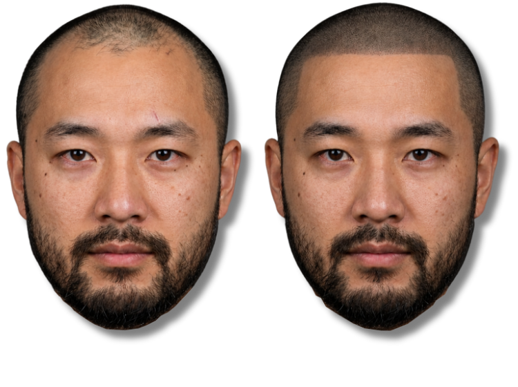 Before and after scalp micropigmentation results for a man with a receding hairline and thinning hair.