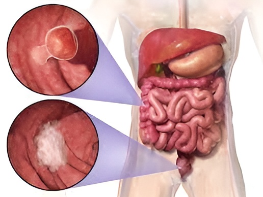 Imagen de Cáncer de Colon utilizado en la pagina web de la Dra. Arlenis Guzmán
