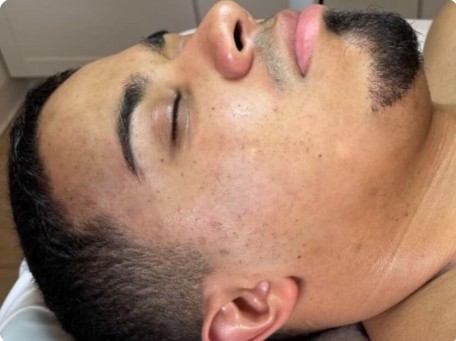 after mcironeedling results after 4 procedures