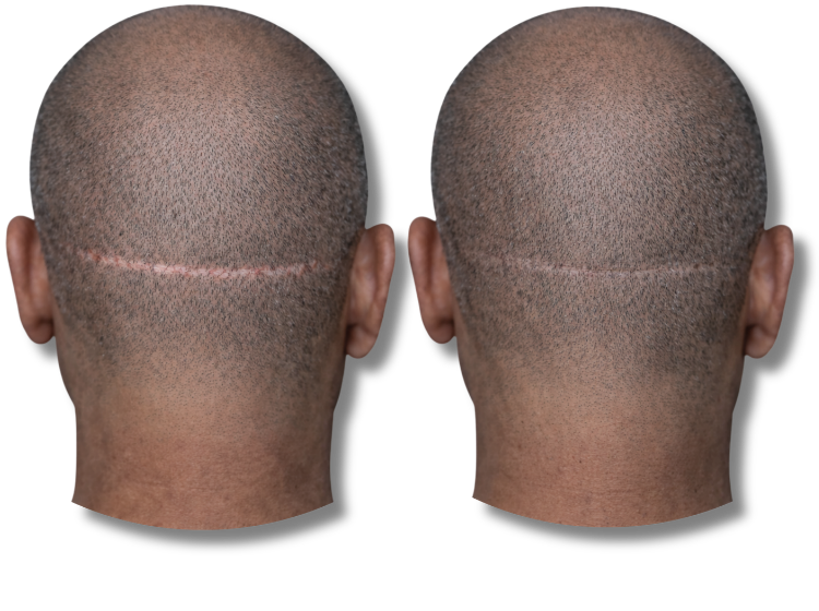 Before and after scalp micropigmentation results for concealing a linear hair transplant scar.