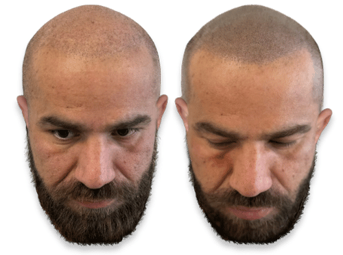 Before and after scalp micropigmentation results for a man with a buzzed haircut to treat hair loss.