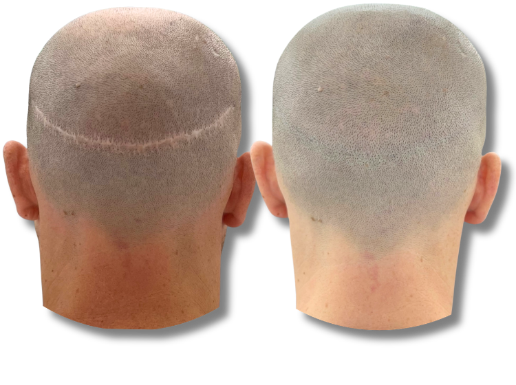 Before and after scalp micropigmentation results for FUT hair transplant scar camouflage.