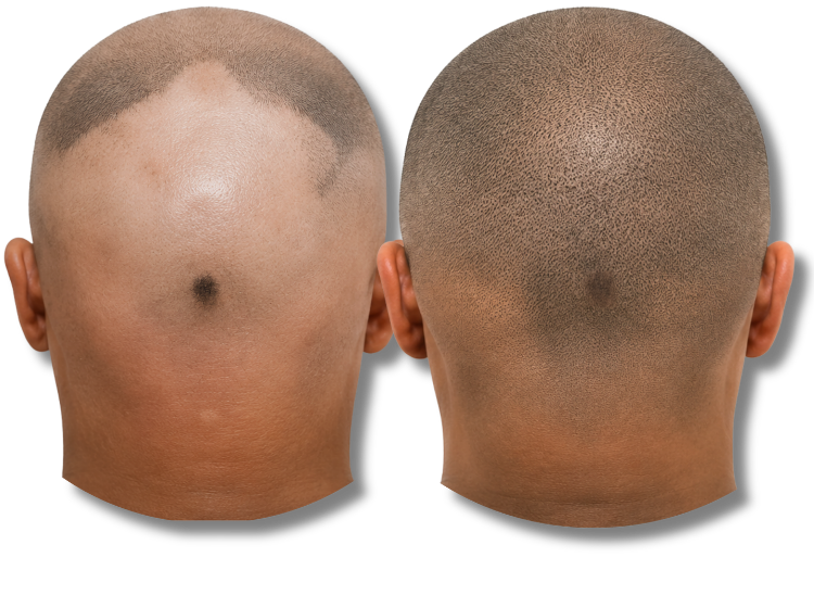 Before and after scalp micropigmentation treatment for male pattern baldness and hair loss.