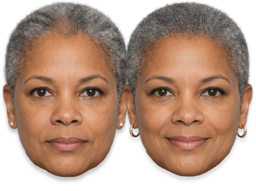 Before and after comparison of a woman's SMP results for thinning gray hair.