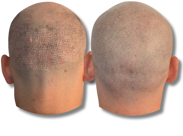 Before and after scalp micropigmentation results for a shaved head with hair follicle density.