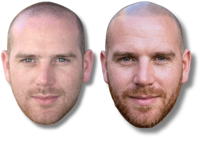 Before and after scalp micropigmentation results on a man with a shaved head and beard.