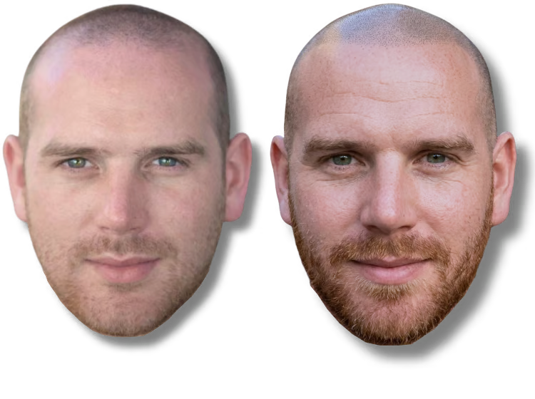 Before and after scalp micropigmentation results for a man with a shaved head and beard.