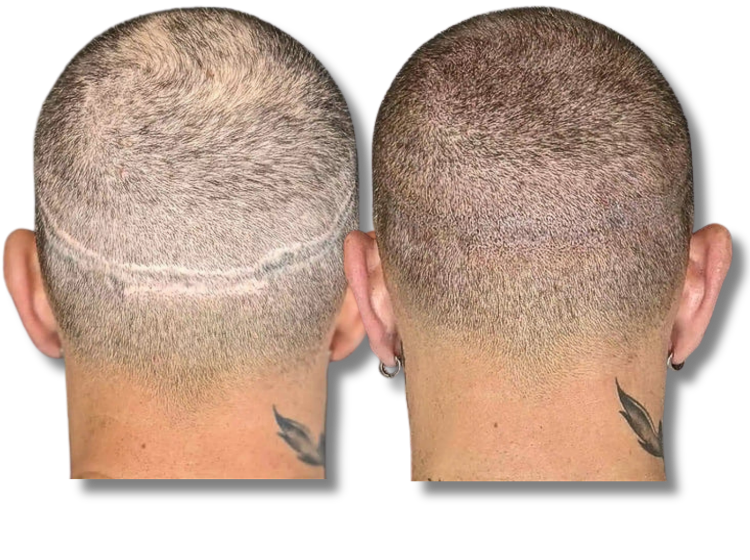 Before and after scalp micropigmentation for concealing a hair transplant FUT scar.