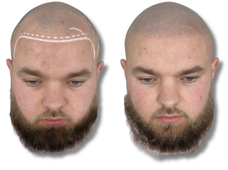 Before and after scalp micropigmentation for a natural-looking hairline and hair loss treatment.
