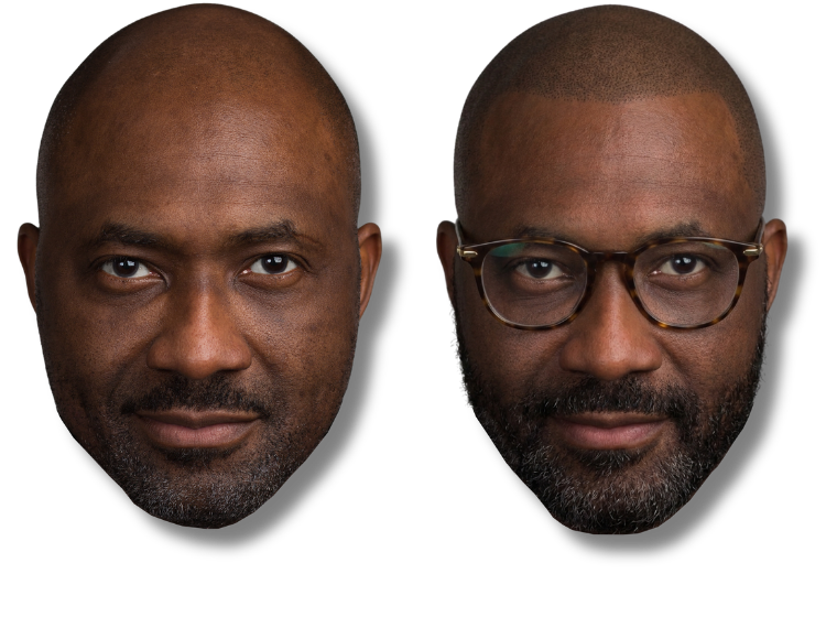 Before and after results of scalp micropigmentation for hair loss on a smiling bald man.