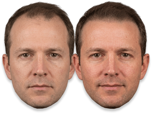 Before and after SMP results showing improved hairline and hair density in a middle-aged man.