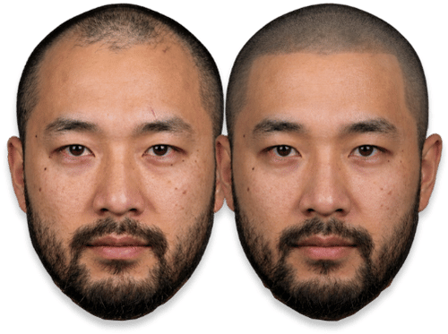 Before and after scalp micropigmentation showing a man's restored hairline for thinning hair treatment.