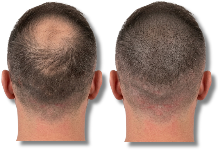 Before and after scalp micropigmentation for male pattern baldness and thinning crown.
