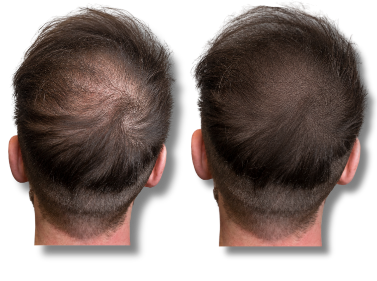 Before and after hair transplant results showing increased density and hair growth on a man's crown.