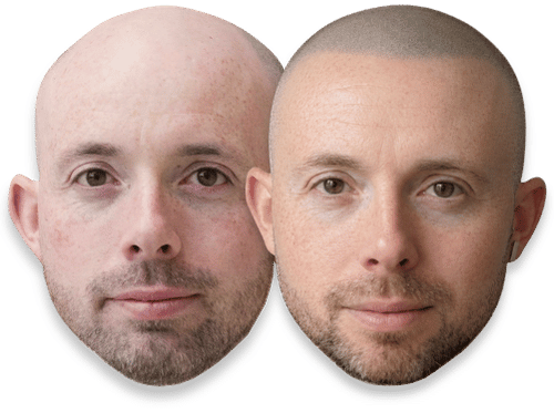 Before and after comparison of scalp micropigmentation for hair loss on a bald man's head.