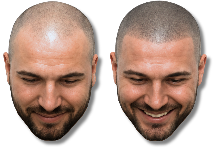 Before and after scalp micropigmentation treatment for male pattern baldness and hair thinning.