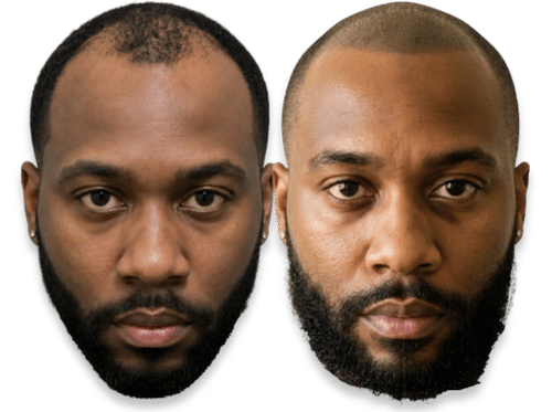 Before and after scalp micropigmentation results for a man with a thinning hairline and male pattern baldness.
