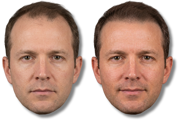 Before and after SMP results showing improved hairline density for men.