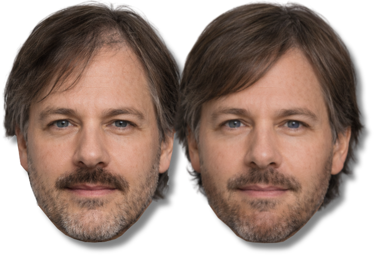 Before and after comparison of hair SMP on a man with a beard.