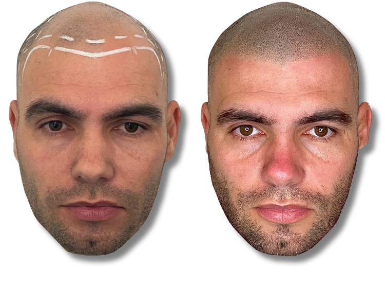 Before and after scalp micropigmentation treatment showing a restored hairline and denser hair follicles on a bald man.