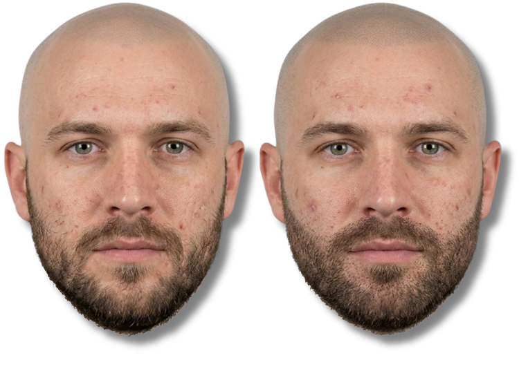 Before and after face comparison of a man with acne and skin blemishes on a black background.